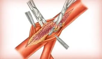 Porto Alegre recebe especialistas internacionais em cirurgia vascular 